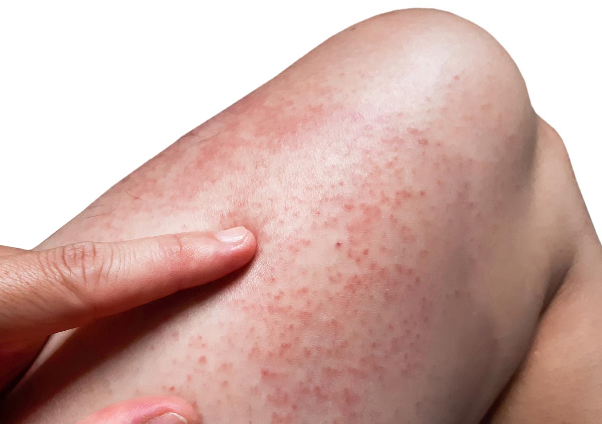 allergy rashes vernon hills